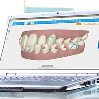 Approve the computerized alignment of your teeth
