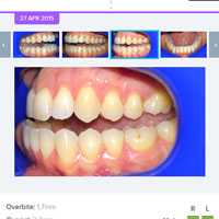Orthodontic Monitoring through your smartphone to watch your progress